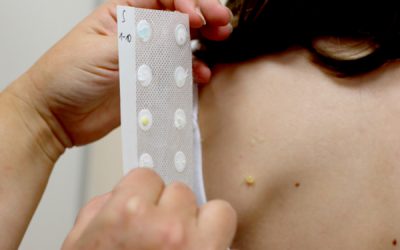 Kontaktallergien nachweisen mit dem Patch-Test
