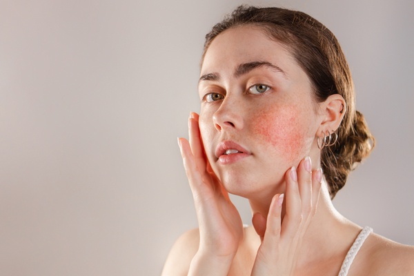 Rosacea – eine chronische Hautkrankheit