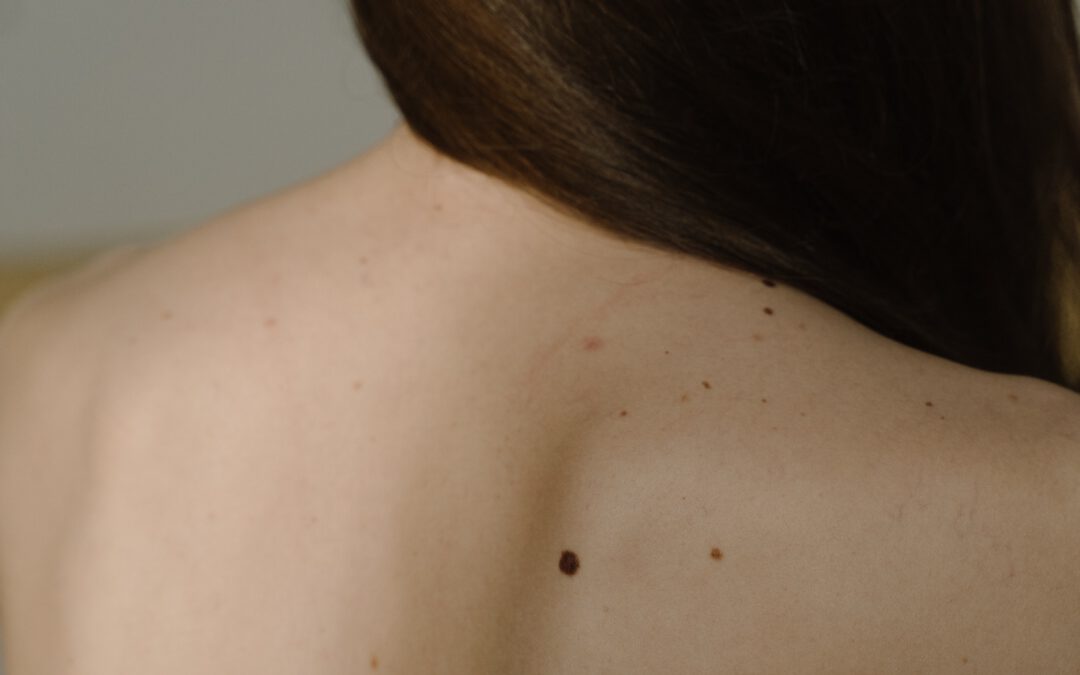 Dermatologie Tempelhof-Hautkrebsvorsorge Melanom Blogbeitragsbild