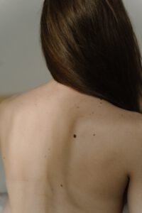 Dermatologie Tempelhof-Hautkrebsvorsorge Melanom Blogbeitragsbild