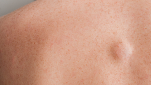 Lipome entfernen lassen in der Praxis der der Dermatologie Tempelhof