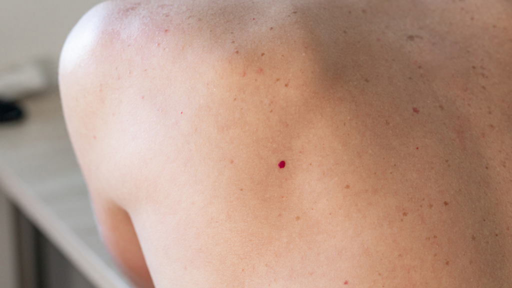 Leukämie Winzige Rote Punkte Auf Der Haut www.dermatologie-tempelhof.de