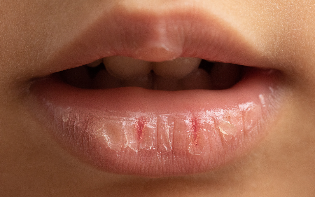 Nahaufnahme von porösen und trockenen Lippen einer Frau