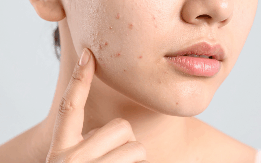 Zyklus & Haut: Wie Hormone das Hautbild beeinflussen und welche Pflege wirklich hilft