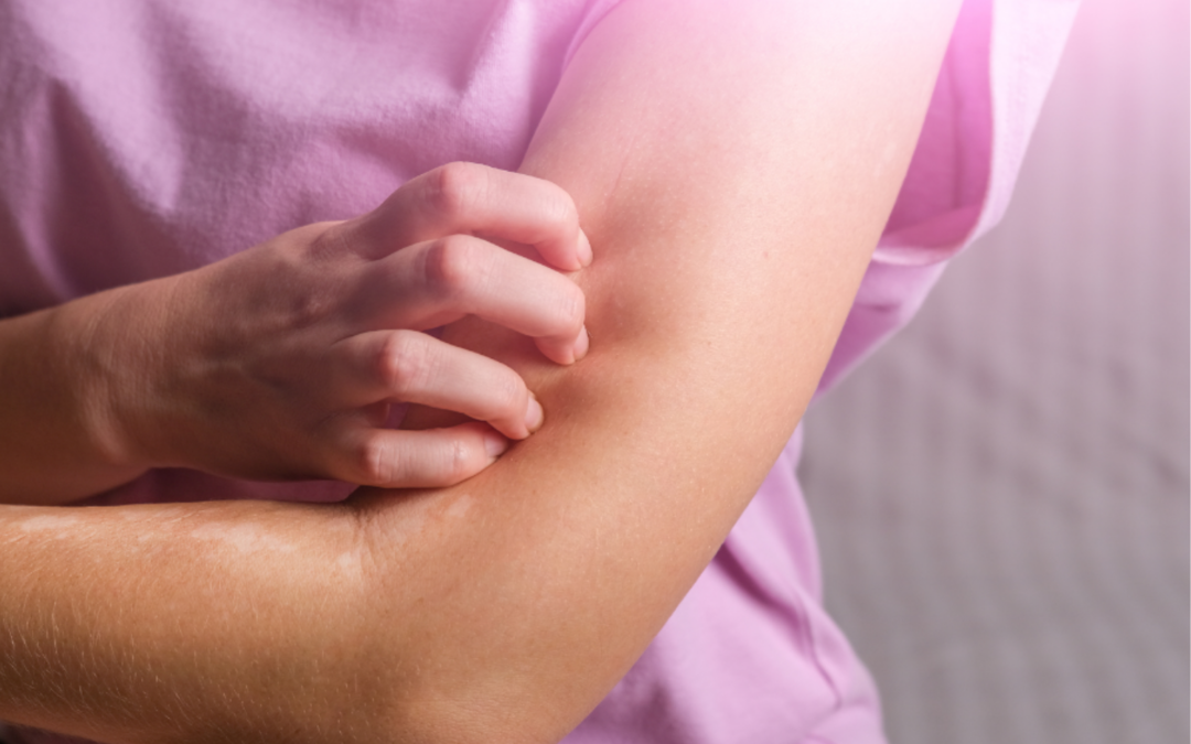 Neurodermitis: Wenn die Haut dauerhaft empfindlich bleibt