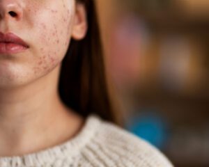 Darm-Haut-Achse Erkrankungen. Darmmikrobiom Hauterkrankung