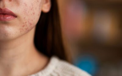 Darm-Haut-Achse – Warum Darmgesundheit essenziell für ein klares Hautbild ist